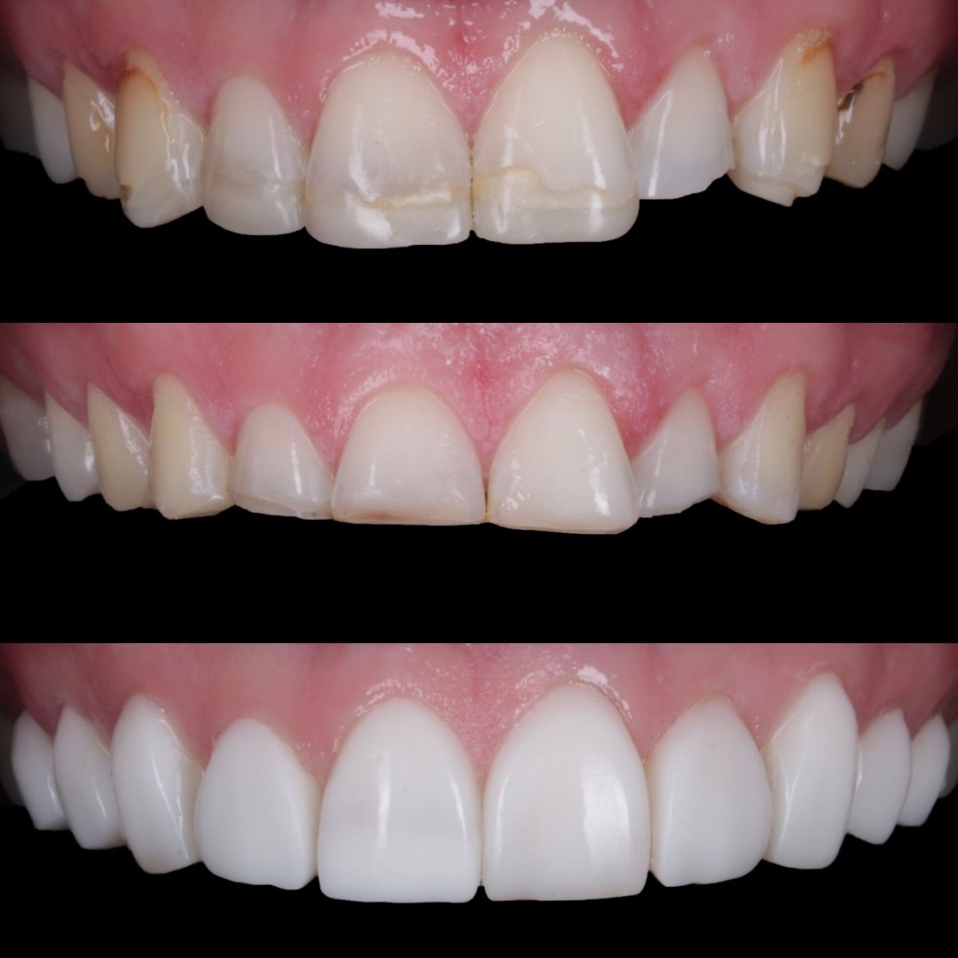 Composite Bonding Cambridge Dental