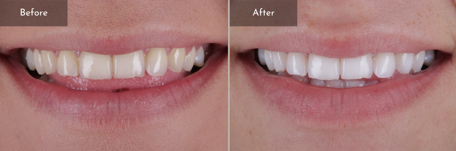 Enlighten teeth whitening cambridge