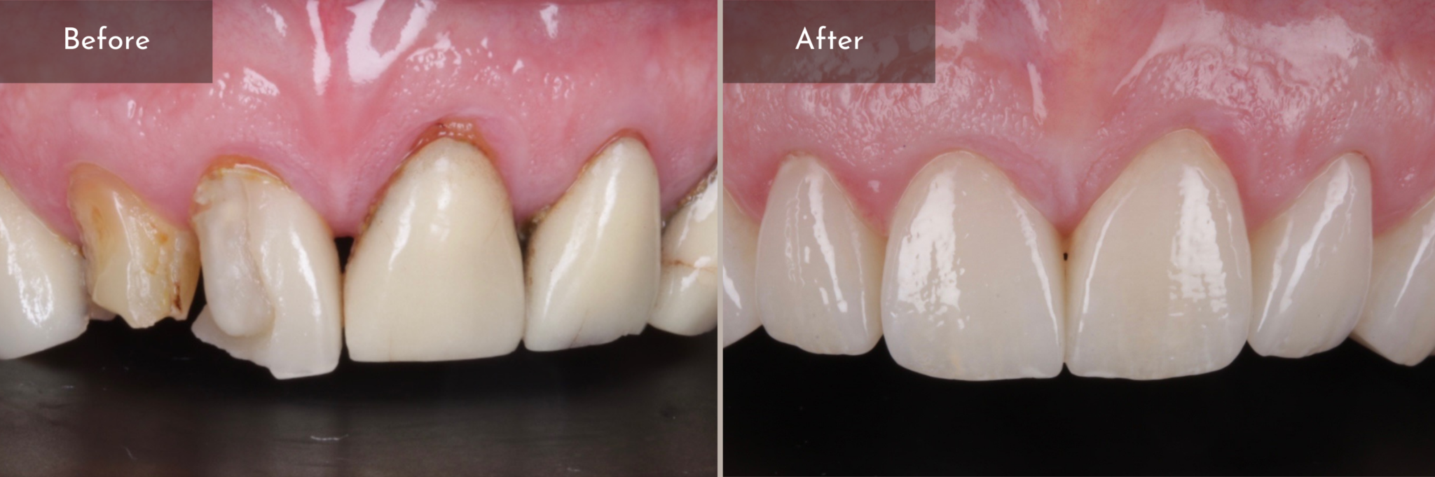 Crown, Inlays and Onlays Cambridge Dental